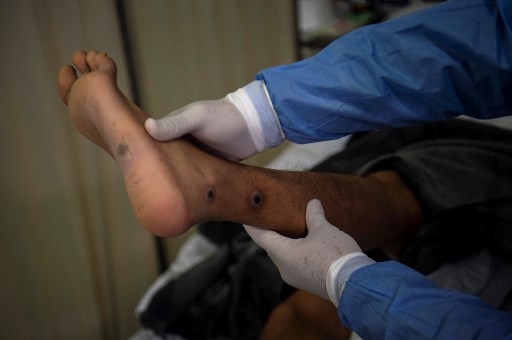 quinto caso,viruela del mono,monkeypox,costa rica,noticias