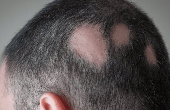 Alopesia,píldora,EEUU