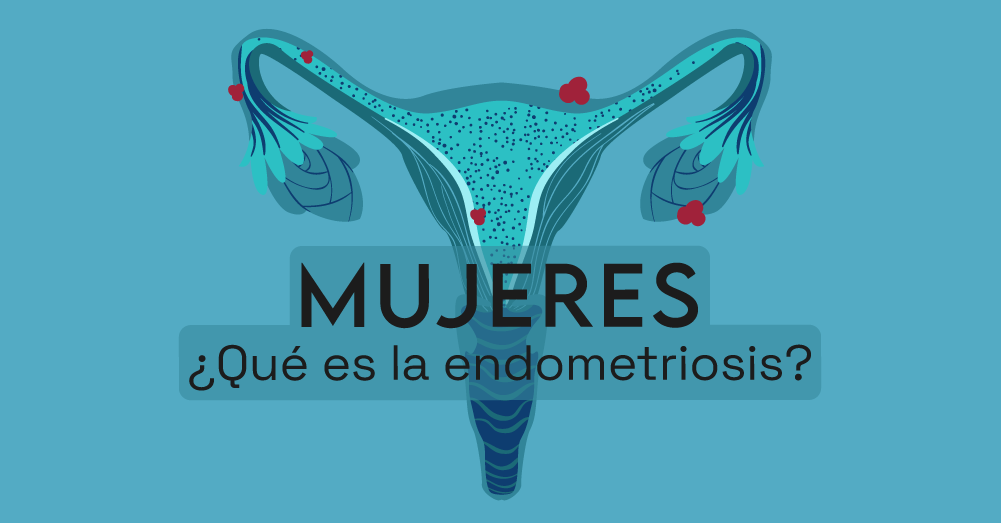 ¿qué Es La Endometriosisemk 1615