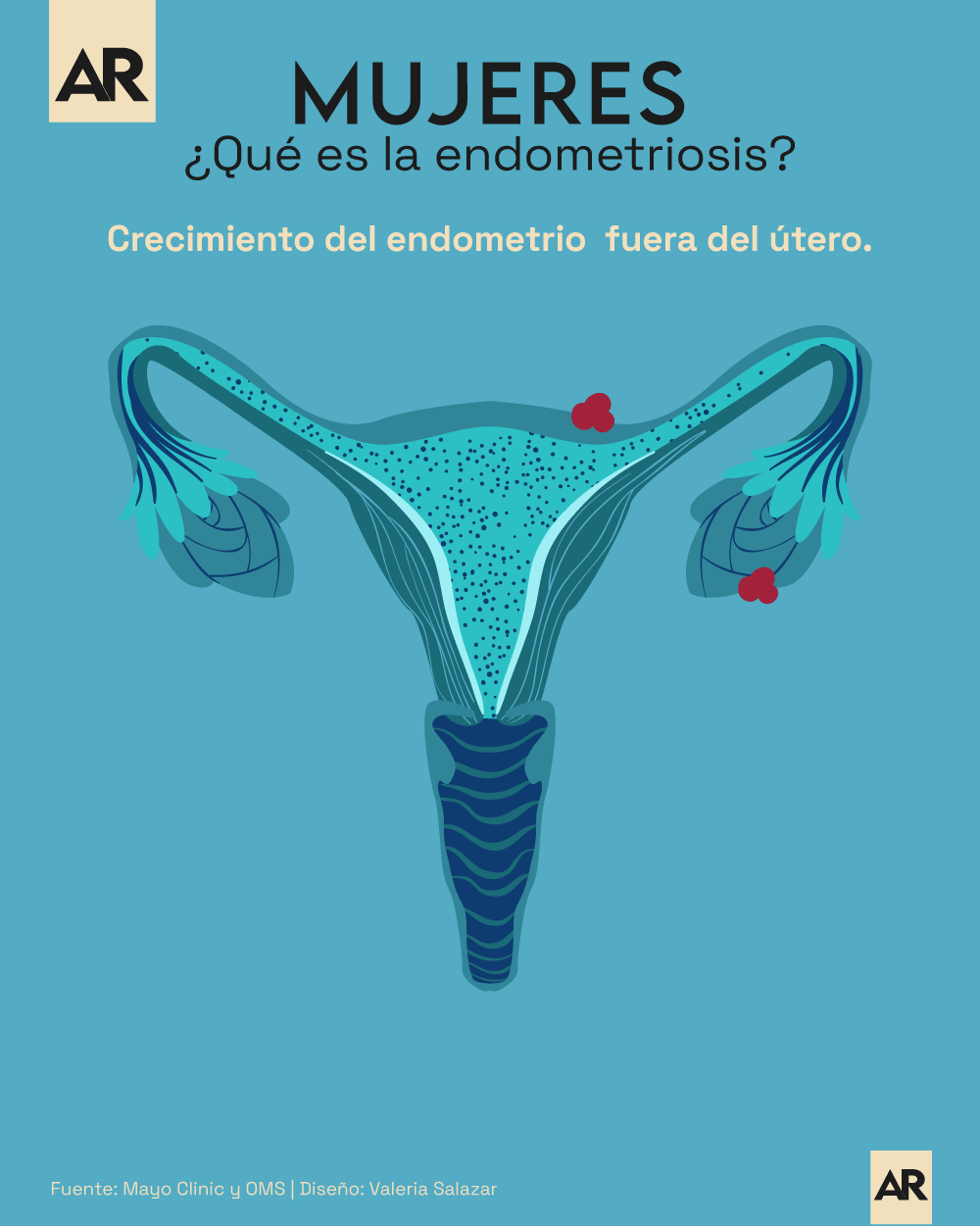 ¿qué Es La Endometriosisemk 7852